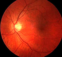 Fundus Oculi